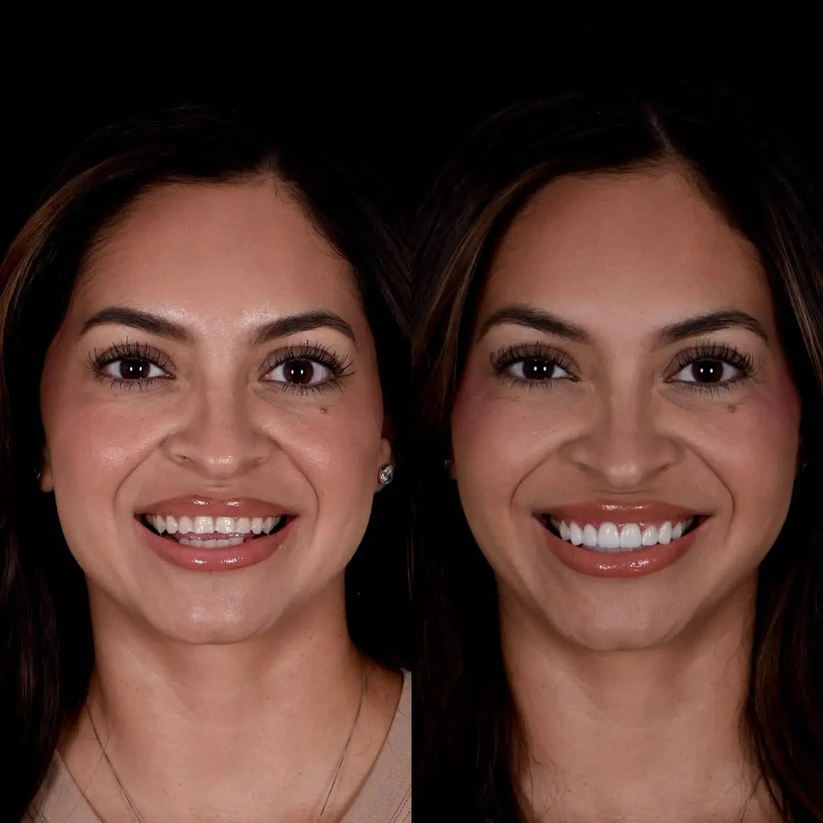 Whitevelle™ Instant Smile Veneers - Pure XO