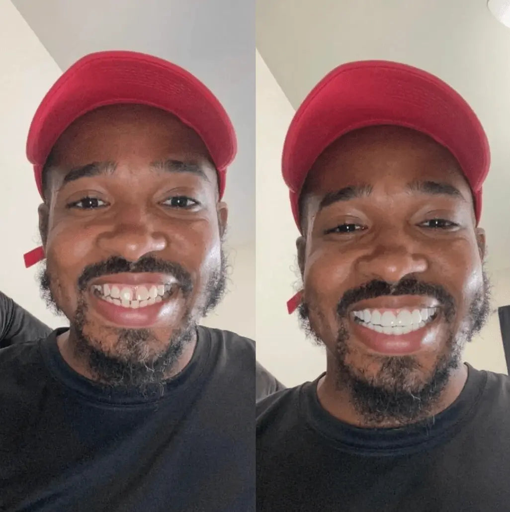 Whitevelle™ Instant Smile Veneers - Pure XO