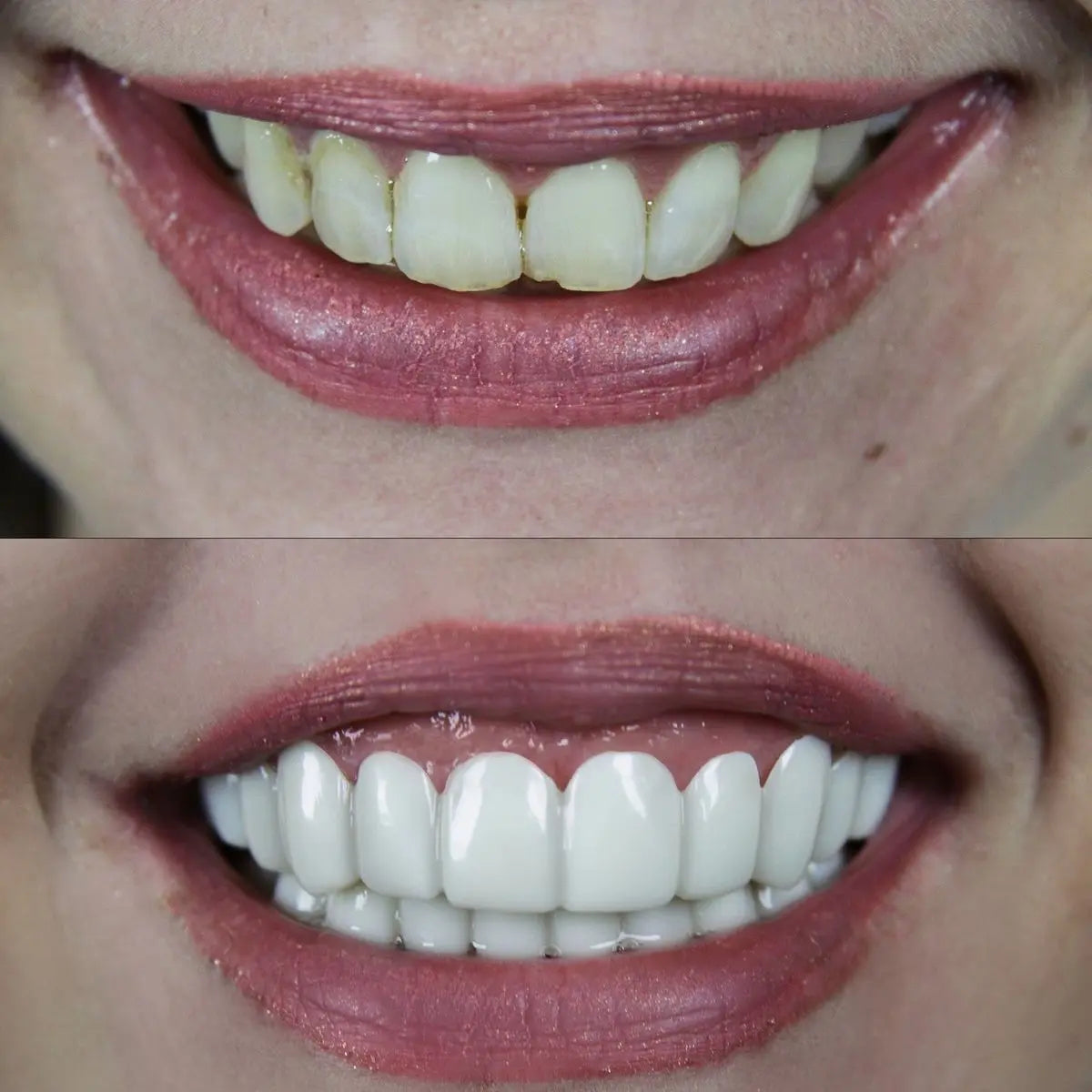 Whitevelle™ Instant Smile Veneers - Pure XO