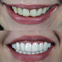 Whitevelle™ Instant Smile Veneers - Pure XO