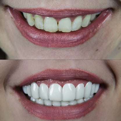 Whitevelle™ Instant Smile Veneers - Pure XO